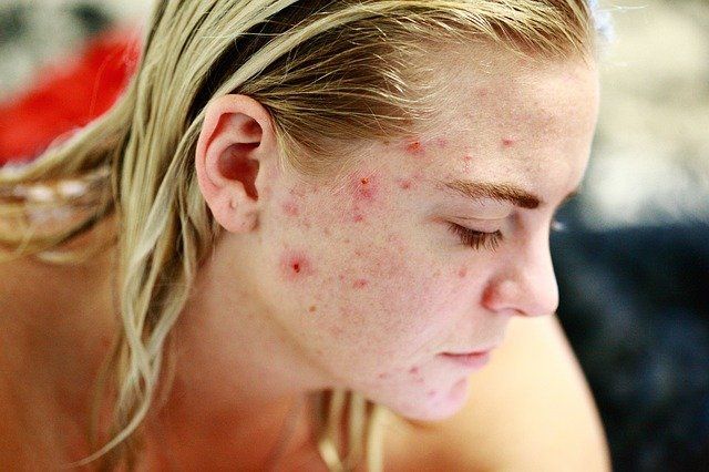 मुँहासे होने के कारण – Cause of Acne In Hindi