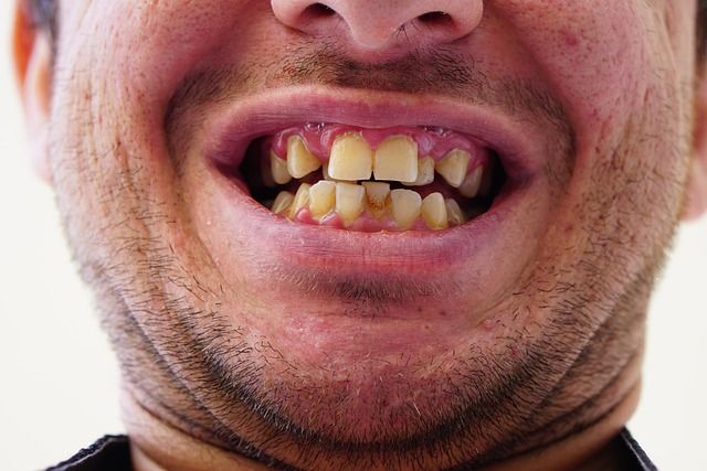 दांतों का पीलापन दूर करने के घरेलू नुस्खे – Home remedies to remove yellowing of teeth